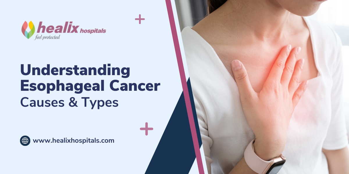 Esophageal Cancer Causes & Types Explained